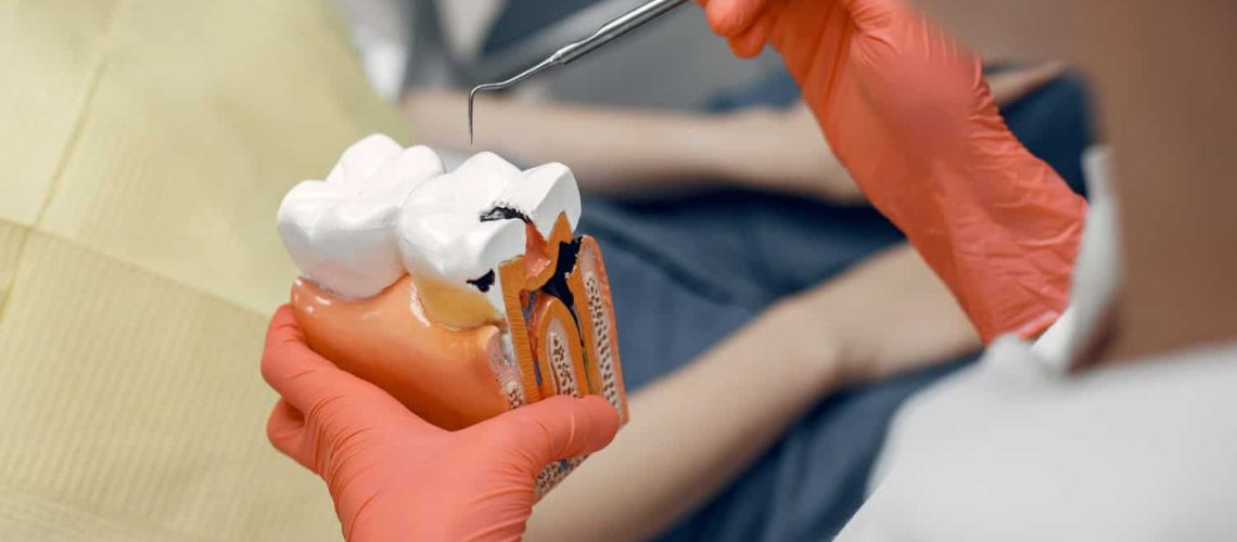 Root Canal Treatment